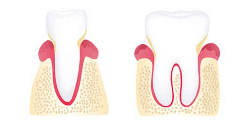 Early Gum Disease Photo