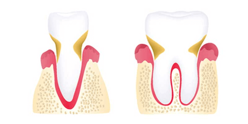 Moderate Periodontitis Photo